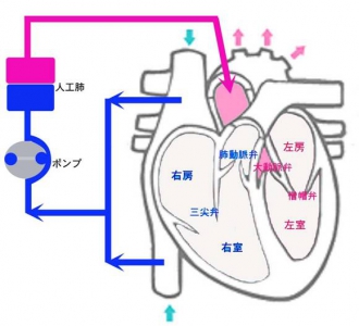 人工 心肺