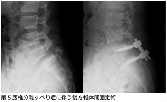 Listhesis