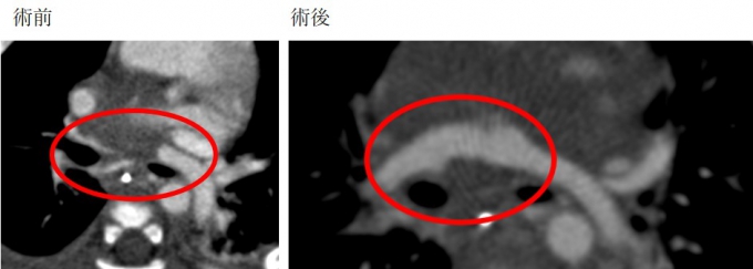 肺動脈形成