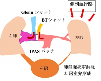 グレン手術