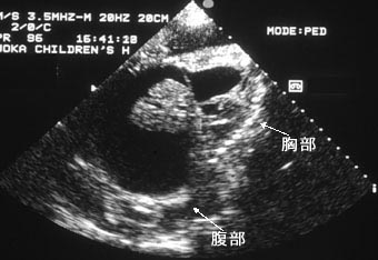 胎児心エコー検査図：図に続いて説明文