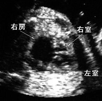 胎児心エコー検査図：図に続いて説明文