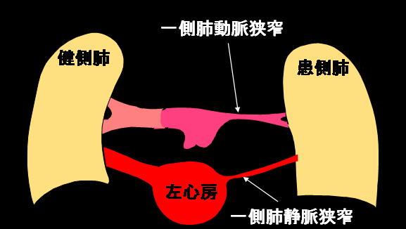 肺動脈内隔壁作成術