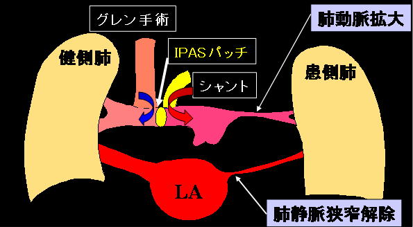 グレン手術