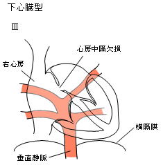 下心臓型III