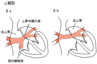 心臓型IIa・IIb