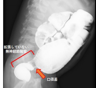 ヒルシュ診断