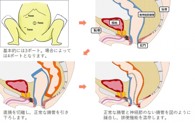 腹腔鏡Duhamel