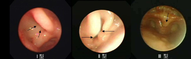 喉頭軟化画像1