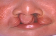 両側唇裂 術前