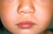 片側唇裂 術後