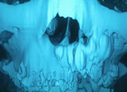 【写真2】顎裂部 骨移植 術後