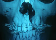 【写真1】顎裂部 骨移植 術前