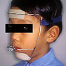 【写真4】上顎牽引装置（上顎全体の成長を促し反対咬合を治療する）