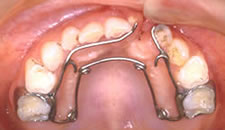 【写真5】上顎拡大装置（歯並びのアーチを整える）
