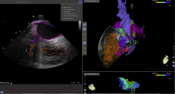 図1:CARTO3システムによる心臓MRIと心腔内超音波エコー画像と不整脈のマッピングの融合