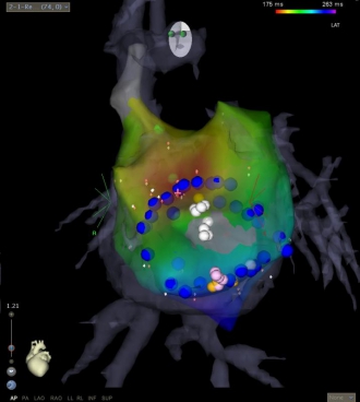 twin AV node(二重房室結節)のマッピング