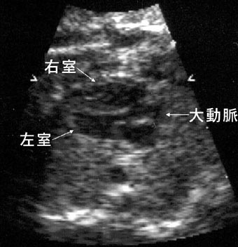 エコー検査図：図に続いて説明文