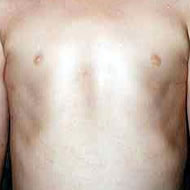 6歳男児 手術後