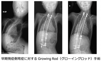 早期発症側弯症に対する Growing Rod（グローイングロッド）手術