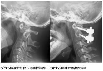 ダウン症候群に伴う環軸椎亜脱臼に対する環軸椎整復固定術