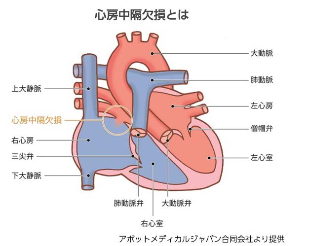 心房中隔欠損とは