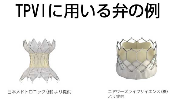 TPVIに用いる弁の例