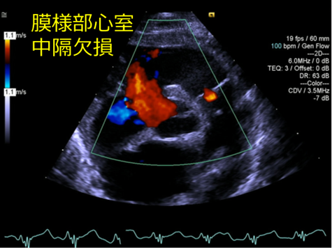 心室中隔欠損（VSD）