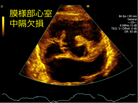 心室中隔欠損（VSD）