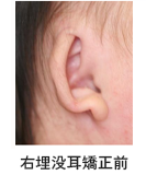 右埋没耳矯正前