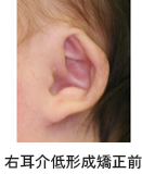 右耳介低形成矯正前