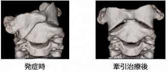 発症時、牽引治療後