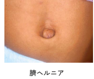 臍ヘルニア