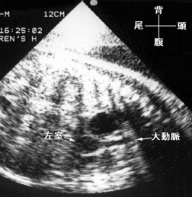 胎児心エコー検査図：図に続いて説明文