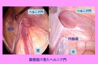 腹腔鏡で見たヘルニア門