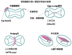 使用頻度の高い房室弁形成の技術