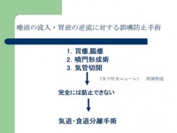 唾液の流入・胃液の逆流に対する誤嚥防止手術のフロー