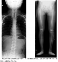 機能性側弯