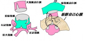 ジャテーン手術