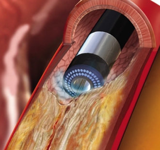 ELCA（エキシマレーザー冠動脈形成術）このレーザー光を動脈硬化の起こった冠動脈内の病変組織に照射することによって、閉塞した血管を開通させます。（© Koninklijke Philips N.V., 2004 - 2019. All rights reserved.）