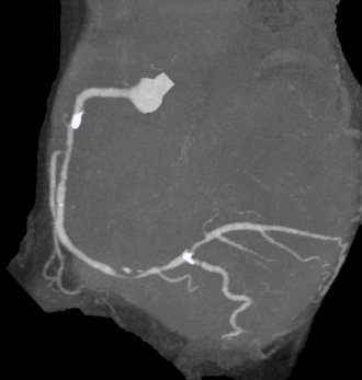 胸痛で来院された患者さん。右冠動脈に高度狭窄が疑われる