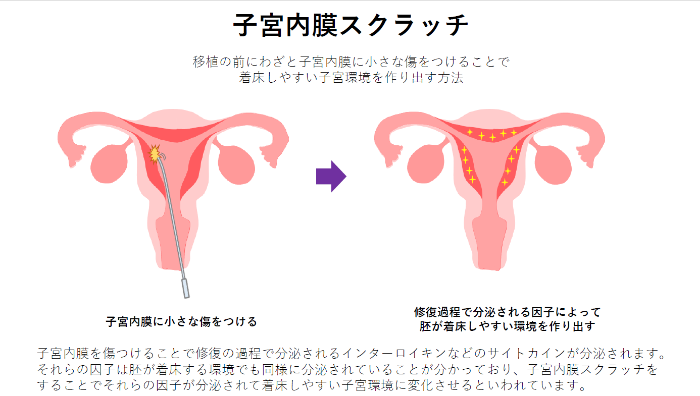 子宮内膜スクラッチ