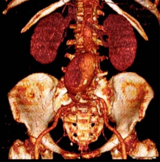 手術前(7cm腹部大動脈瘤)