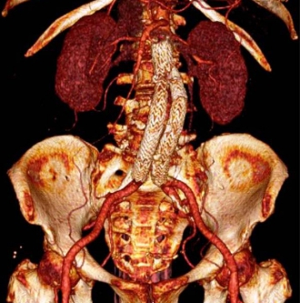 手術後(ステントグラフト治療)