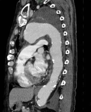 巨大な破裂性遠位弓部大動脈瘤(術前)
