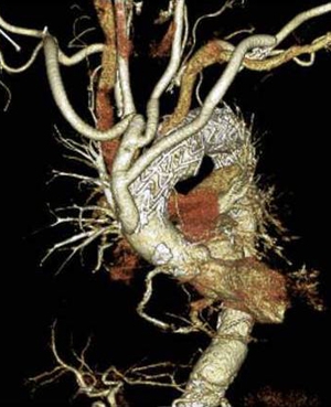 頸部分枝の再建をしてステントグラフトを上行大動脈から下行大動脈まで挿入した(ハイブリッド手術後)