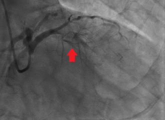 急性心筋梗塞の患者さん。左前下行枝の閉塞を認める(矢印)