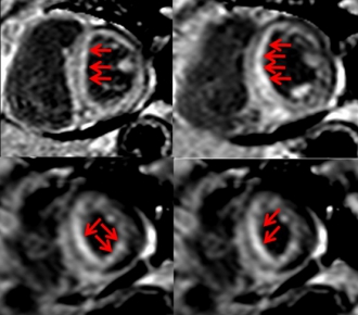 心アミロイドーシスの症例。心内膜側全体に遅延造影を認める（矢印）。