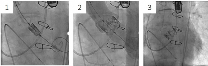 バルーン拡張型人工弁
