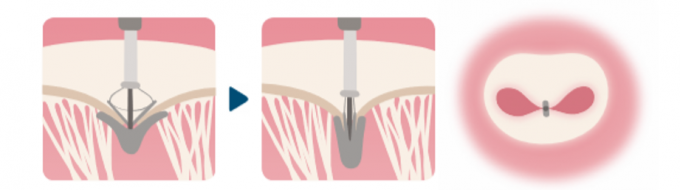 カテーテル手法により僧帽弁逆流を軽減する治療